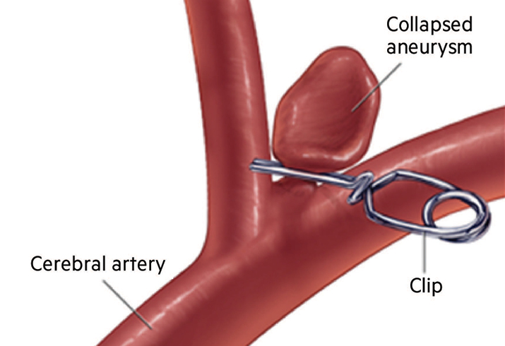 Surgical Clipping Brain Aneurysm Foundation