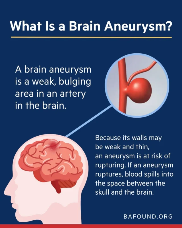 A brain aneurysm is a weak, bulging area in an artery in the brain. Because the walls may be thin, an aneurysm is at risk of rupturing. If it ruptures, blood can spill into the space between the skull and the brain, which is a life-threatening emergency. Learn more at bafound.org.