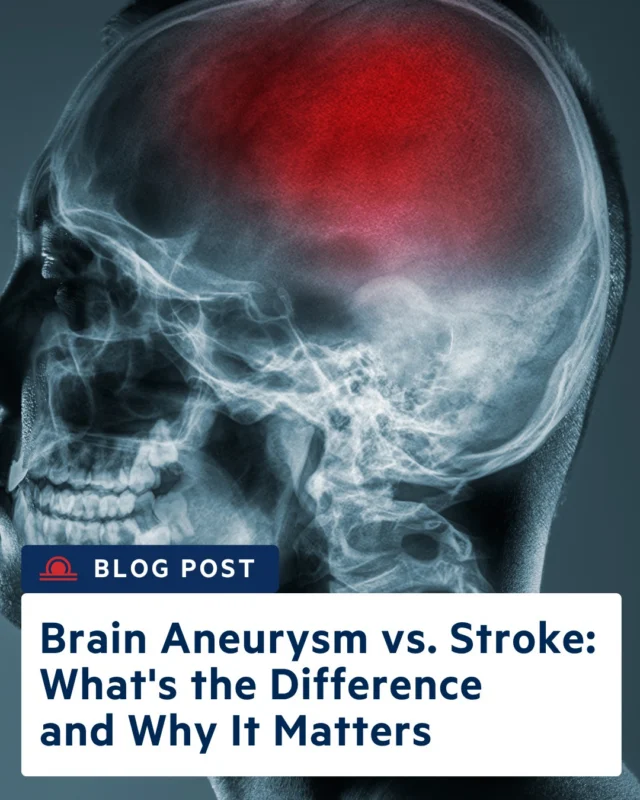 Stroke or brain aneurysm — would you know the difference in an emergency?

A sudden “worst headache of your life,” facial drooping, arm weakness, or trouble speaking should never be ignored. While brain aneurysms and strokes are different conditions, they can overlap in life-threatening ways, and knowing the warning signs could save a life.

Read this blog to learn the key differences between brain aneurysms and strokes, common symptoms, risk factors, and when to seek emergency care immediately, https://www.bafound.org/blog/brain-aneurysm-vs-stroke-whats-the-difference-and-why-it-matters/