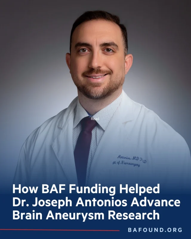 BAF-funded researcher Joseph Antonios, MD, PhD, (@drjosephantonios) of Yale School of Medicine (@yale_neurosurgery), used advanced immune profiling to study inflammatory cells inside human intracranial aneurysms — research now published in Neurology.

This work brings us closer to therapies that could predict and prevent aneurysm rupture. Early-stage funding from BAF makes breakthroughs like this possible.

Read the paper here: https://www.neurology.org/doi/10.1212/WNL.0000000000214185