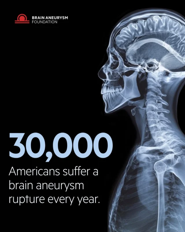 30,000 Americans suffer a brain aneurysm rupture every year. Awareness and early detection can change these odds. Know the warning signs, and share this with someone you love. Know the signs:  https://www.bafound.org/understanding-brain-aneurysms/warning-signs-symptoms/