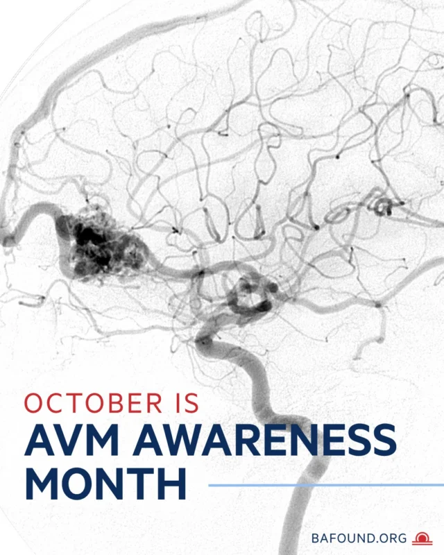 You may know about brain aneurysms, but have you heard of an AVM? October is AVM Awareness Month. An arteriovenous malformation (AVM) is a tangle of abnormal blood vessels that can occur in the brain. If an AVM ruptures, it can cause bleeding in the brain and serious complications. And 10–60% of people with an AVM also have a brain aneurysm. This October, learn the facts and help spread awareness. Learn more at https://www.bafound.org/understanding-brain-aneurysms/arteriovenous-malformations/