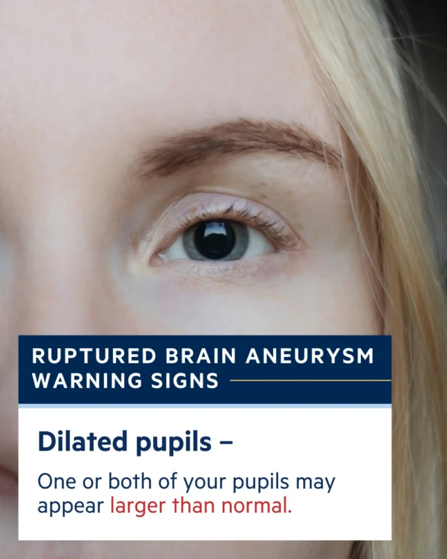 Could you spot the warning signs of a ruptured brain aneurysm? One or both pupils may appear larger than normal — a subtle but important sign. #KnowTheSigns #BrainAneurysmAwareness