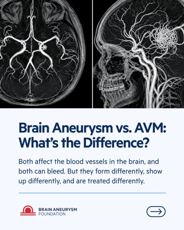 Brain aneurysm vs. AVM: what’s the difference? 
Both are abnormalities in the brain’s blood vessels, and both can rupture. But here’s one key difference: brain aneurysms usually don’t cause symptoms until they rupture, while AVMs can cause symptoms like seizures beforehand, which can give patients time to plan treatment with their doctor. Swipe through for the key differences, then head to the link in bio for the full breakdown on our blog.